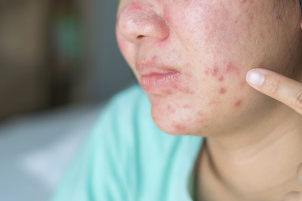 Acne Treatment in Houston TX