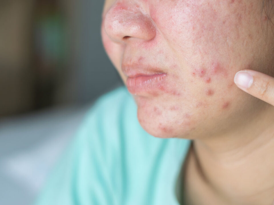 Acne Treatment in Houston