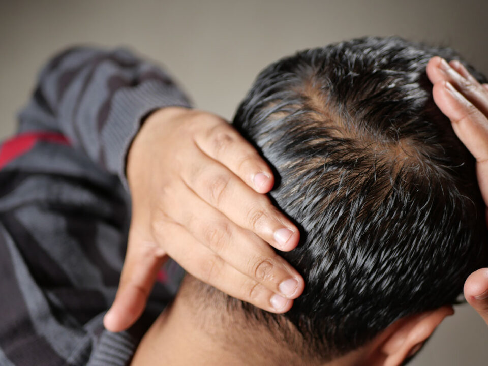 Hair Loss Treatment in Houston