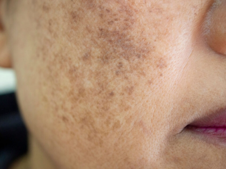 Melasma Treatment in Houston