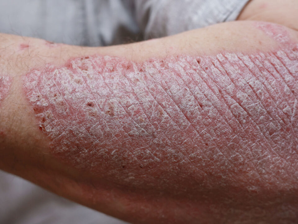 Psoriasis Treatment in Houston