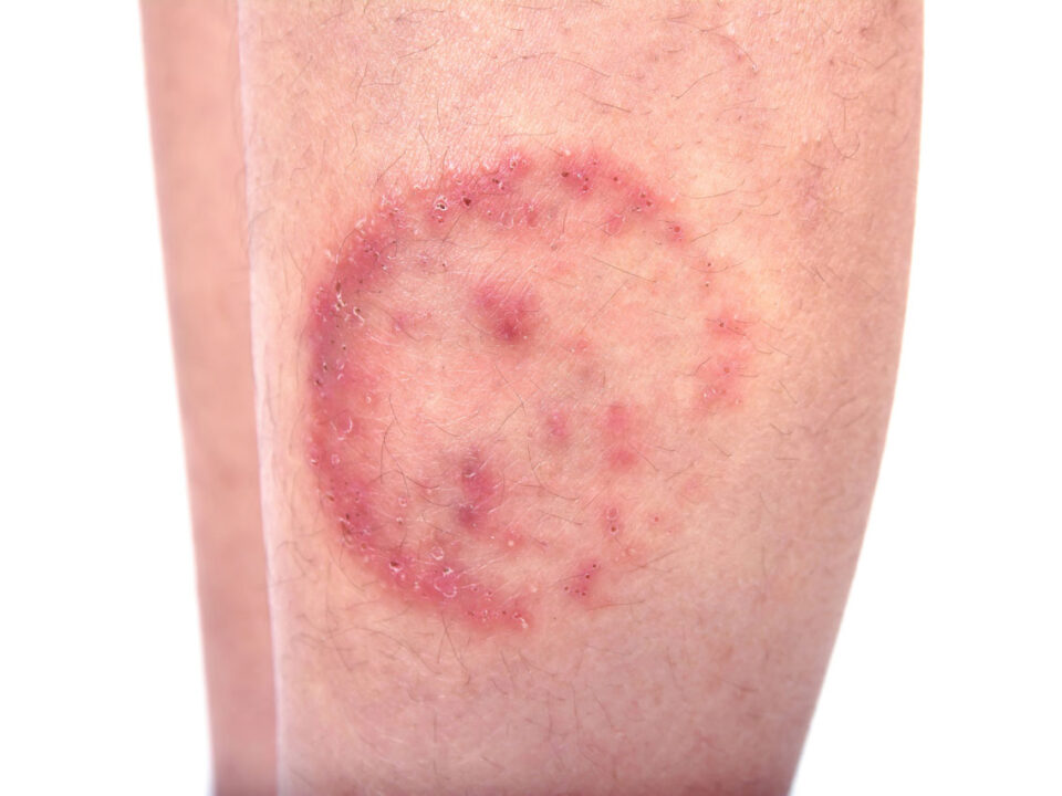 Fungal Infection Treatment in Houston