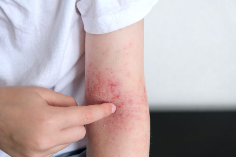 treatment-for-eczema-in-houston-768x512