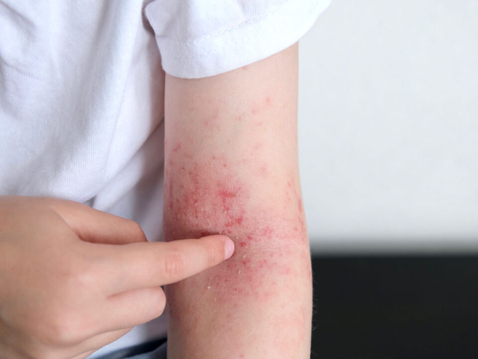 Eczema Treatments in Houston