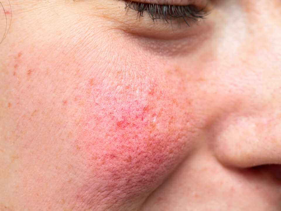 Rosacea Treatment in Houston