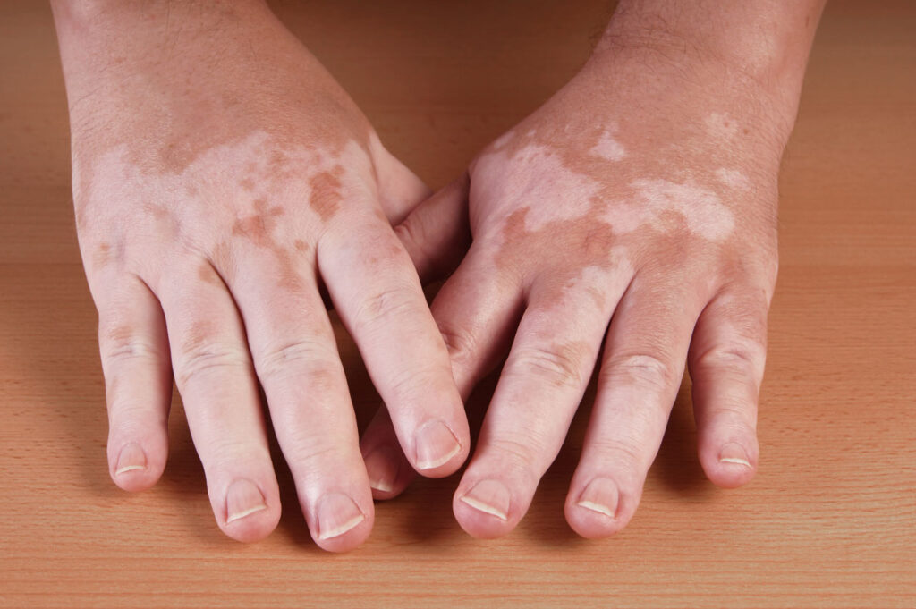 vitiligo treatment houston tx