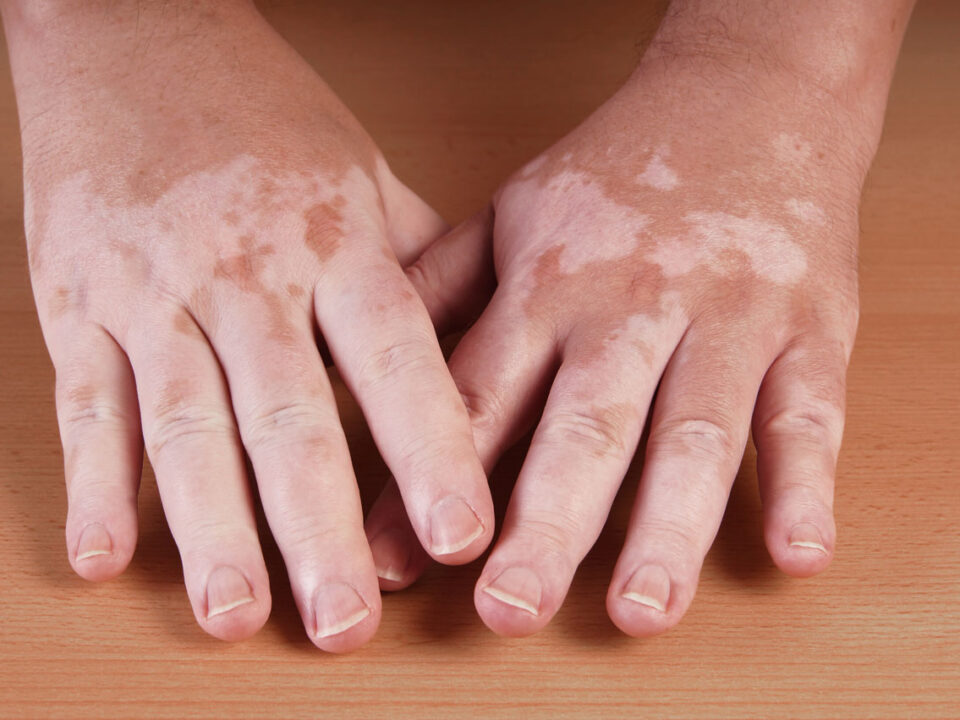 Vitiligo Treatment in Houston