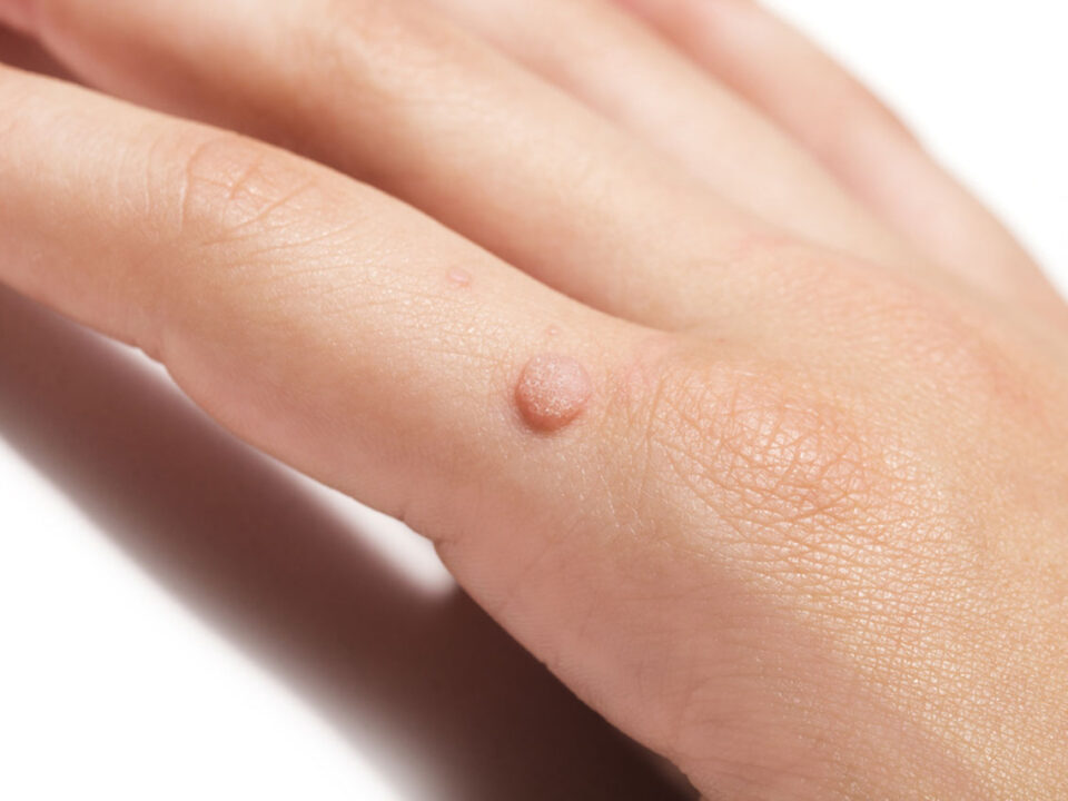 Wart Removal In Houston